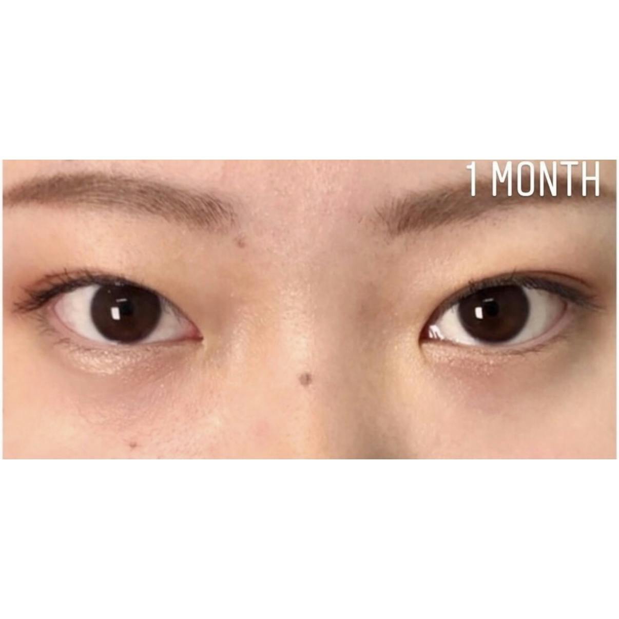 湘南美容クリニック 大阪梅田本院で二重整形・二重自然癒着法(切らない二重手術)・二重埋没・奥二重整形・末広二重整形・平行二重整形・ミックス型二重整形・目元整形を受けたnaagiiさんの写真