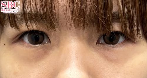 【20代女性・クマ】裏ハムラ法_before