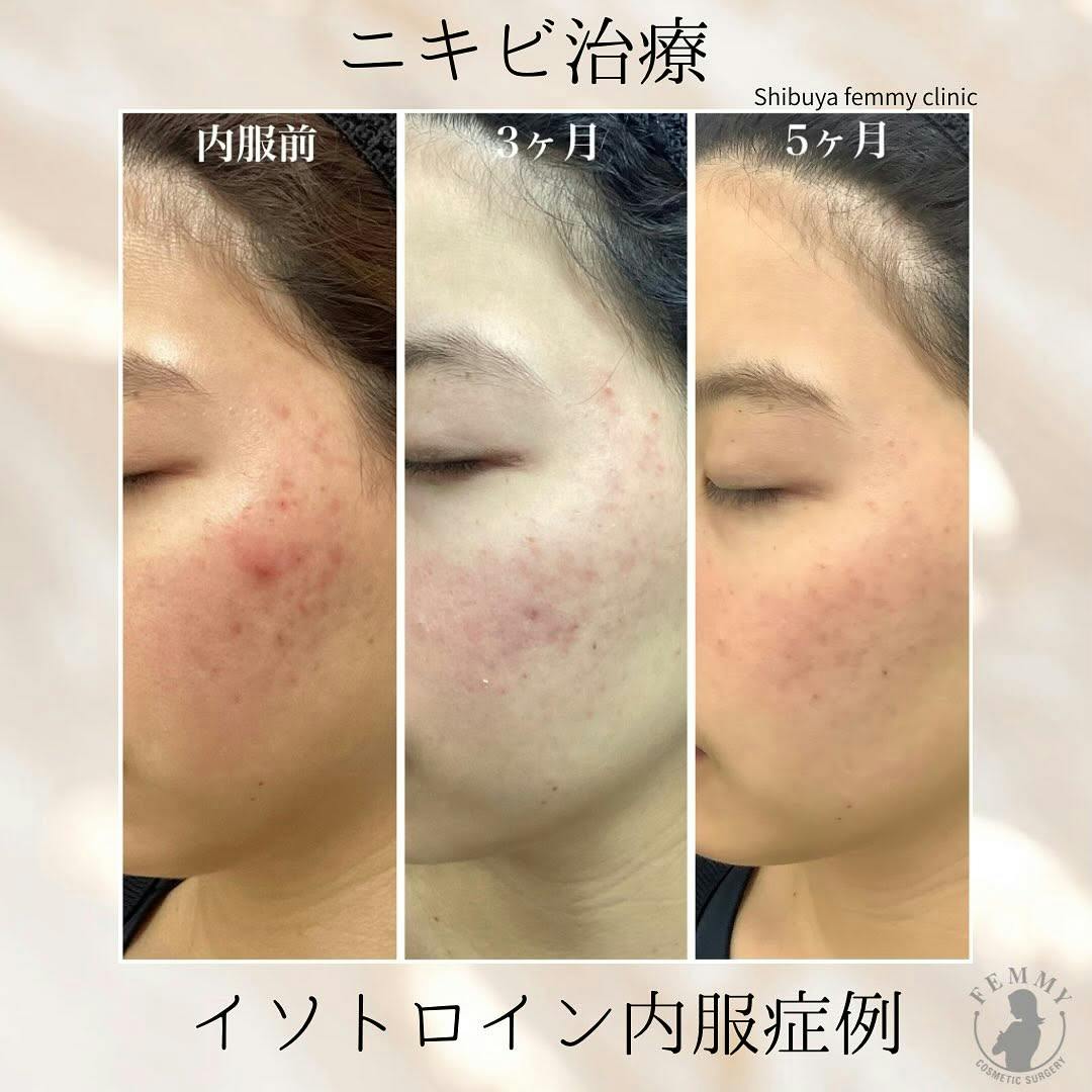 【女性・ニキビ】イソトロイン_before_aftar