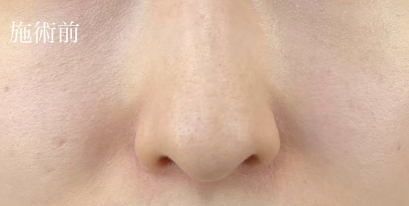 マイプレイスビューティークリニック(my place beauty clinic)でヒアルロン酸注射・注入を受けたサンドモフさんの写真