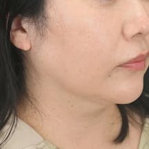 【女性・たるみ】シークレットリフト、プリマリフト、VOV(ボブ)リフト_after