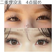 【女性・目元】二重埋没法 4点どめ_before_aftar