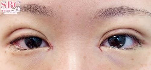 【30代女性・目元】クイックコスメティーク・トリプルNeo、目頭切開プレミアム_justafter