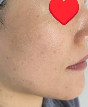 聖心美容クリニック 六本木院でしみを取る施術：しみ取りレーザーを受けたらっきーさんの写真