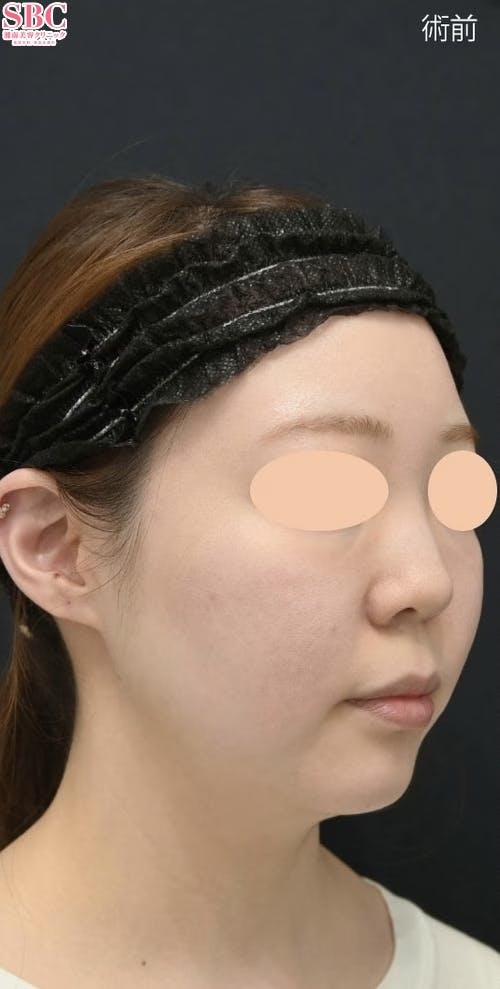 【20代女性・輪郭】根こそぎVASER脂肪吸引_before