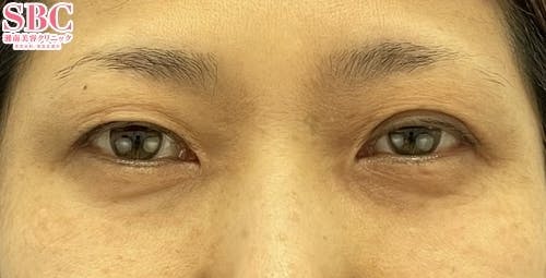 【女性・目元】クイックコスメティーク・ダブルNeo、切らないまぶたのリフトアップ_before