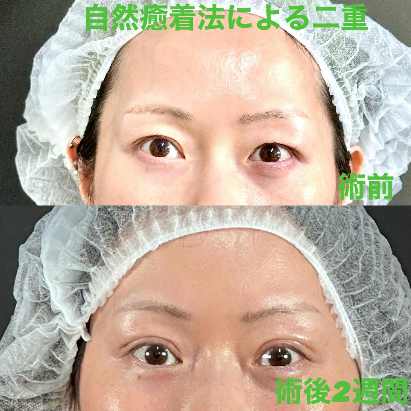 【女性・目元】自然癒着法による二重_before_aftar