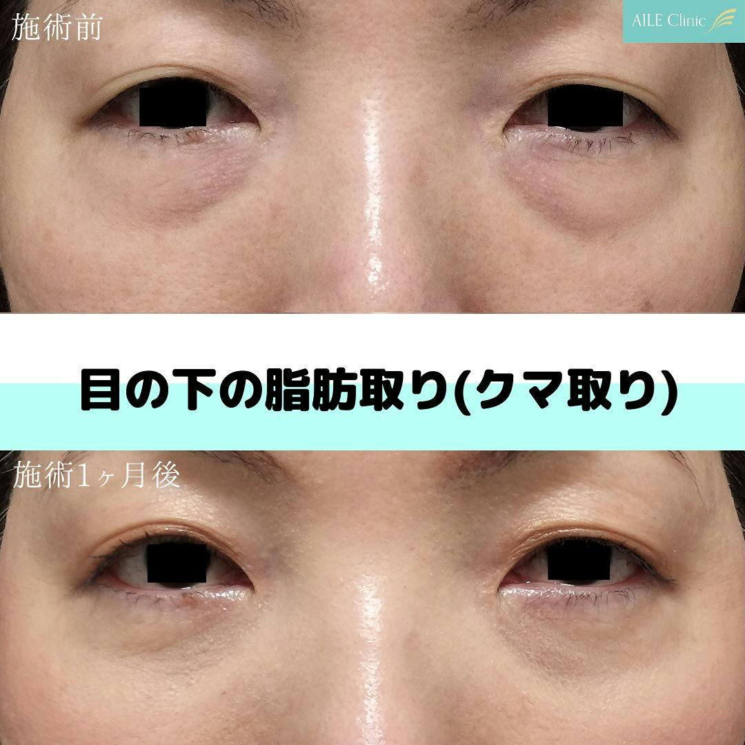 【女性・クマ】目の下の脂肪取り(クマ取り)_before_aftar