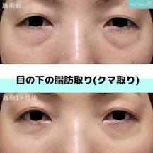 【女性・クマ】目の下の脂肪取り(クマ取り)_before_aftar