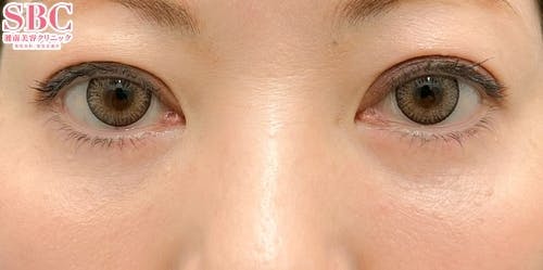 【女性・クマ】切開ハムラ(表ハムラ)法_after