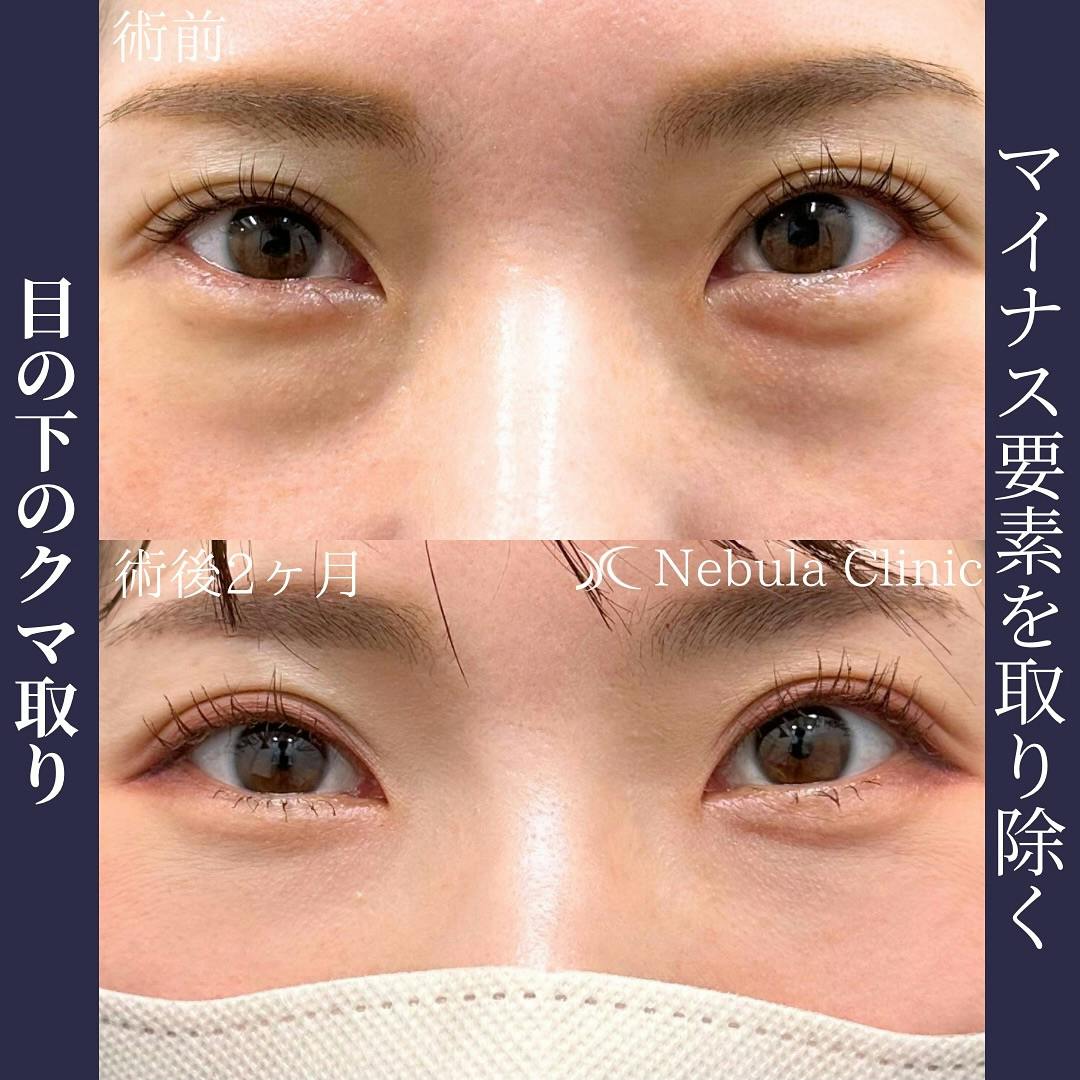 【女性・クマ】切らない目の下のクマ取り・たるみ取り_before_aftar