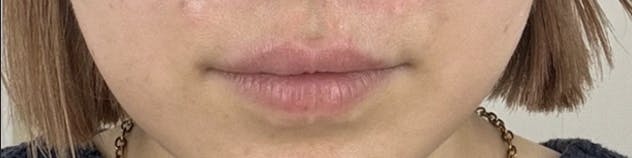 ブルームクリニック(BLOOM CLINIC)で唇ヒアルロン酸&口角ボトックスを受けたしあさんの写真