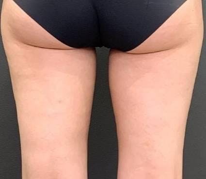 ワムクリニック銀座(WOM CLINIC GINZA)でボディ脂肪吸引：太もも 脂肪吸引を受けたYO～YOさんの写真