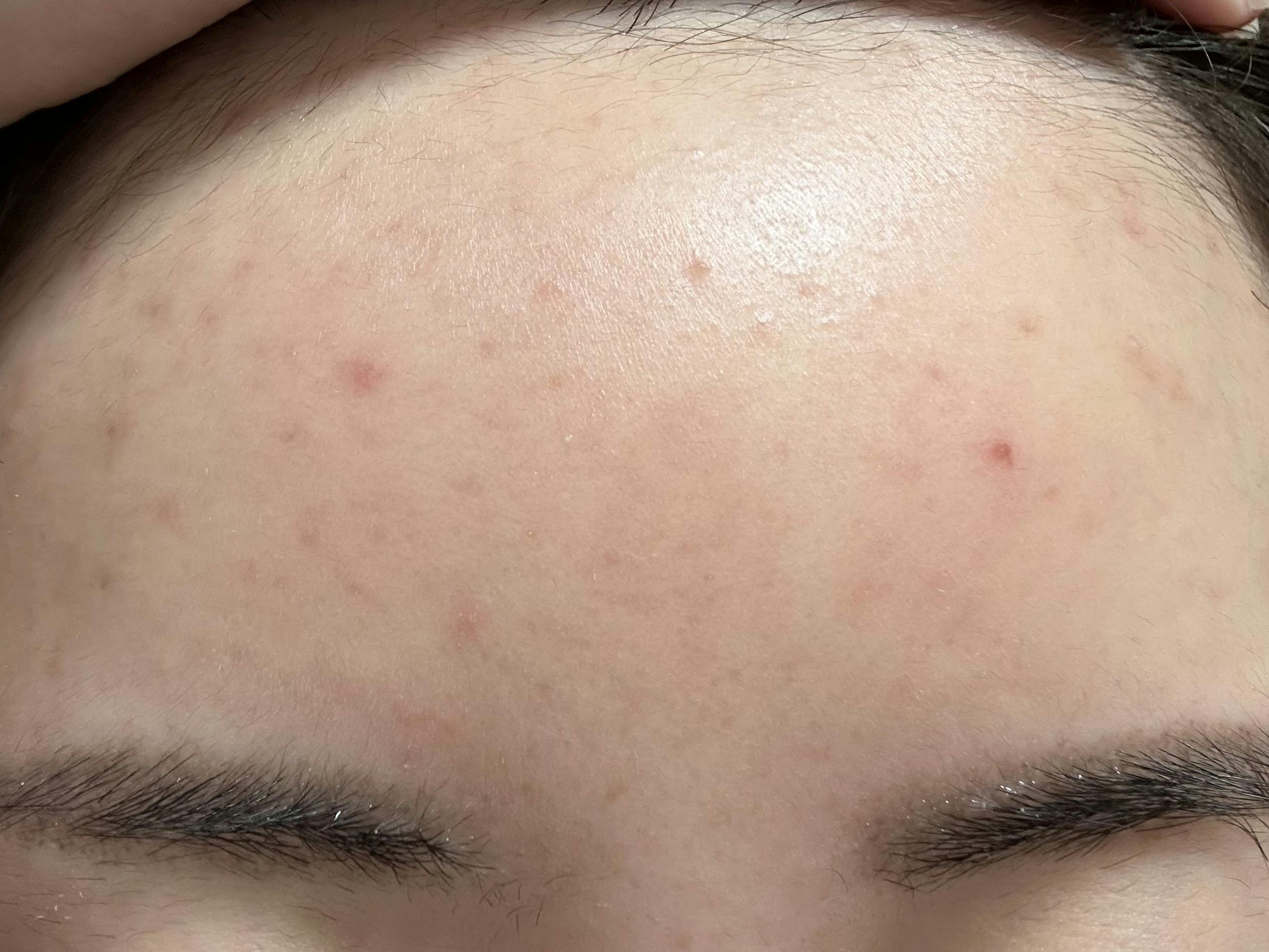ソワカウィメンズヘルスクリニック(sowaka women’s health clinic)でポテンツァを受けたTiさんの写真