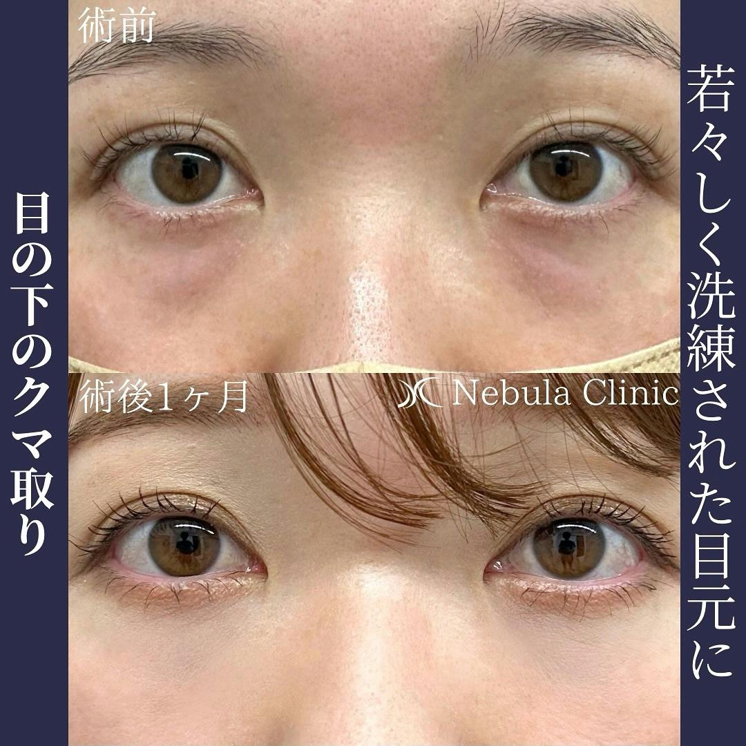 【女性・クマ】切らない目の下のクマ取り・たるみ取り_before_aftar