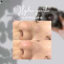 【毛穴】ハイドラジェントル_before_aftar