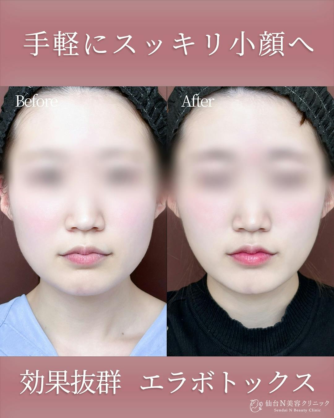 【女性・小顔】エラボトックス_before_aftar