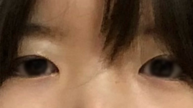 恵聖会クリニック 京橋院で二重埋没を受けたしめじさんの写真