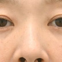 【女性・目元】アイバックリムーブ法、ナチュラル脂肪注射コンデンスリッチ、VOV(ボブ)リフト_aftar