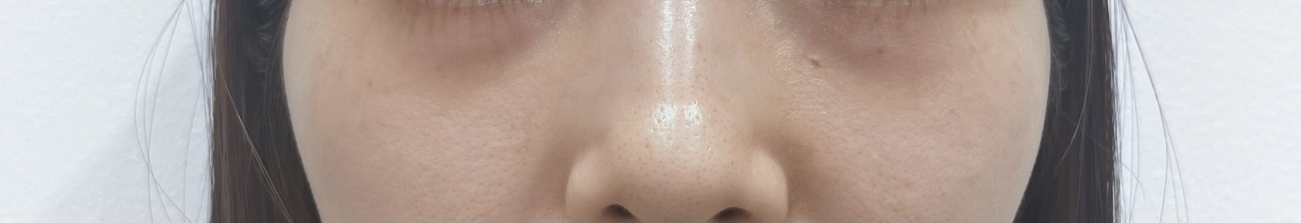 ブリンククリニック(BLINC CLINIC)で目の下のクマ脂肪注入を受けたりりさんの写真