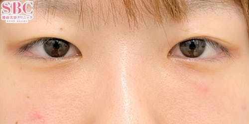 【女性・目元】目の下の切らないクマ・たるみ（ふくらみ）取り、ナチュラル脂肪注射ナノリッチ、ナチュラル脂肪注射コンデンスリッチ_1week