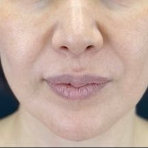 【女性・顔】シークレットリフト、VOV(ボブ)リフト、テスリフト_before