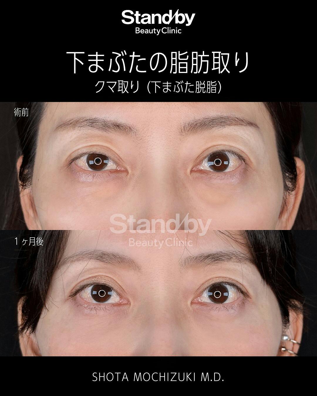 【目元】クマ取り(下まぶた脱脂)_before_aftar