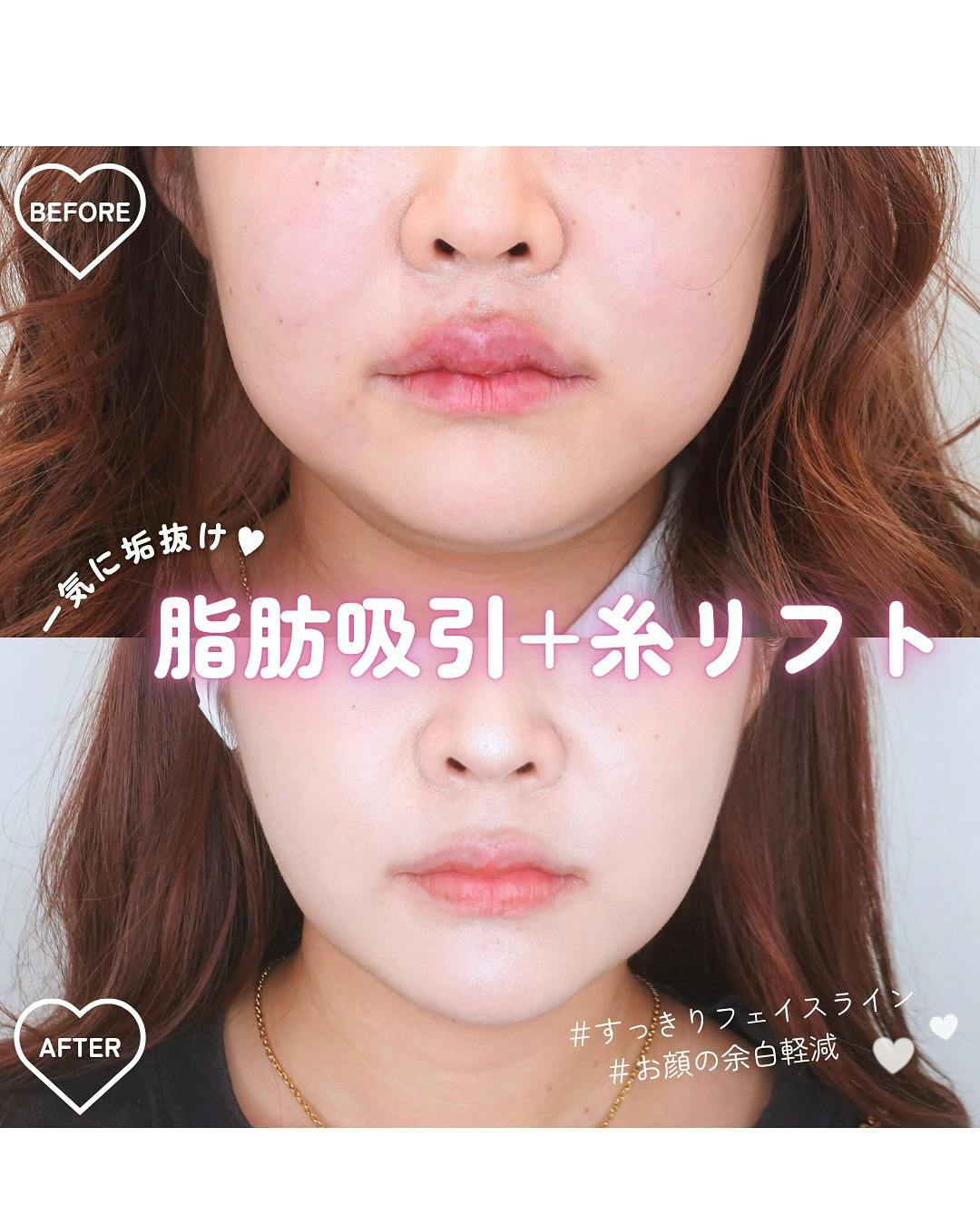 【女性・顔】脂肪吸引+糸リフト_before_aftar