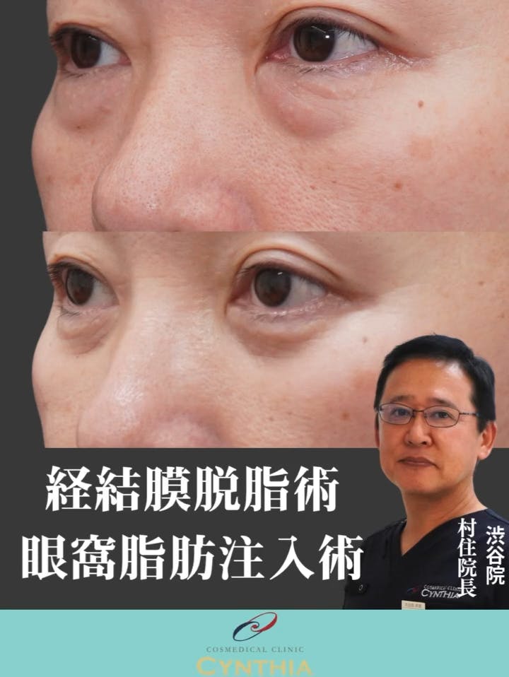 【50代女性・目元】経結膜脱脂・眼窩脂肪注入_before_aftar