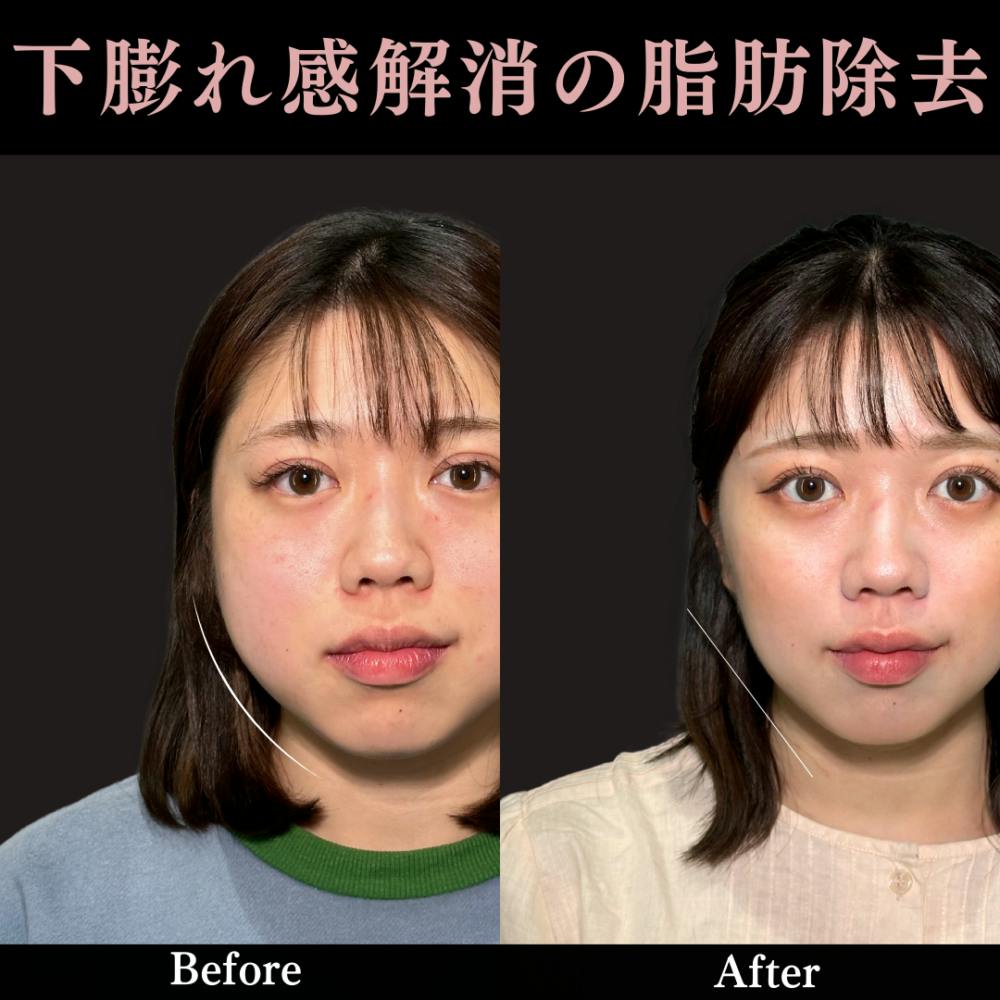 【20代女性・顔】バッカルファット除去＋エラボトックス_before_aftar