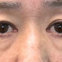 【50代女性・クマ】目の下の切らないクマ・たるみ(ふくらみ)取り、ナチュラル脂肪注射コンデンスリッチ、ナチュラル脂肪注射ナノリッチ_before