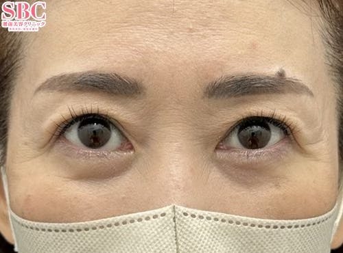 【女性・目元】眼瞼下垂＋二重_after