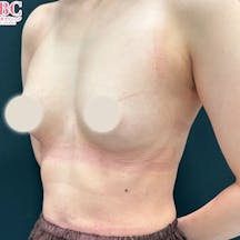 【女性・胸】Motivaエルゴノミックス2(バッグ豊胸)_before