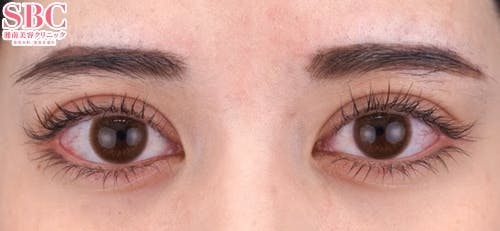 【20代女性・目元】クイックコスメティーク・トリプルNeo_after