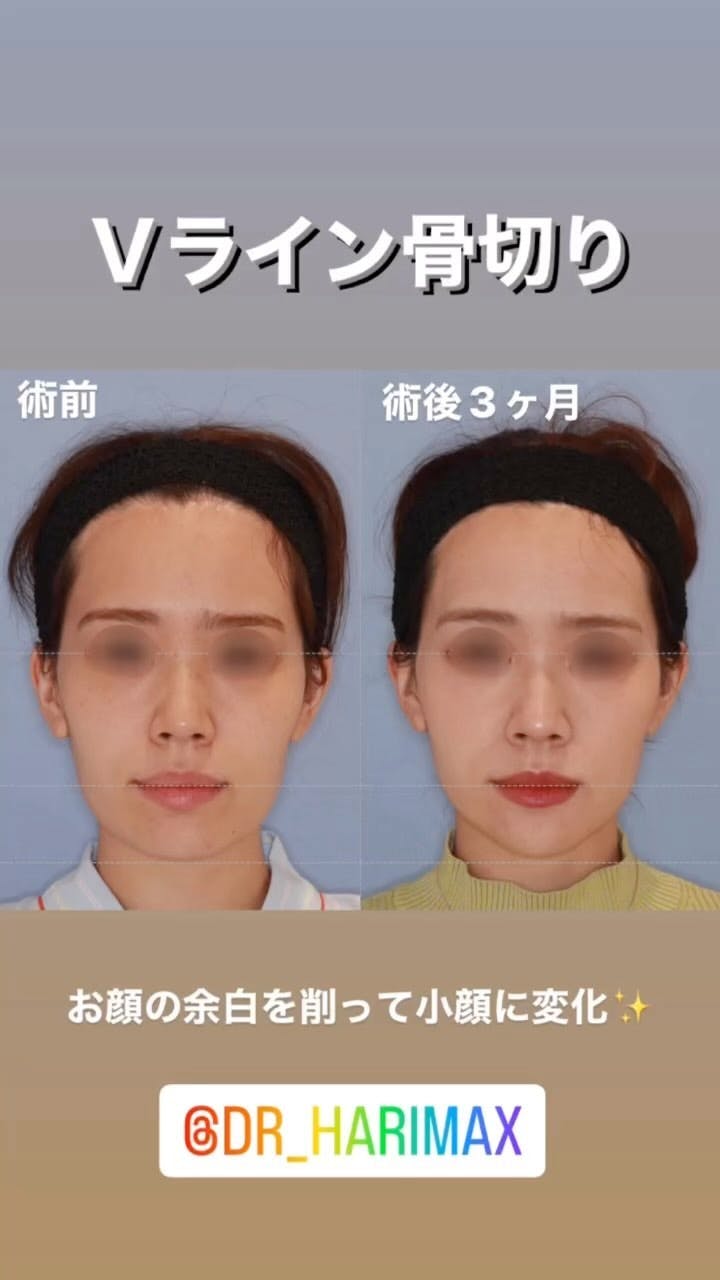 【女性・顔】Vライン骨切り_before_aftar