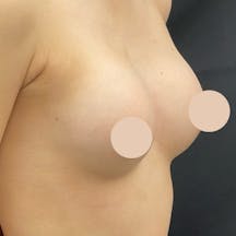 【女性・胸】Motivaエルゴノミックス2(バッグ豊胸)_after