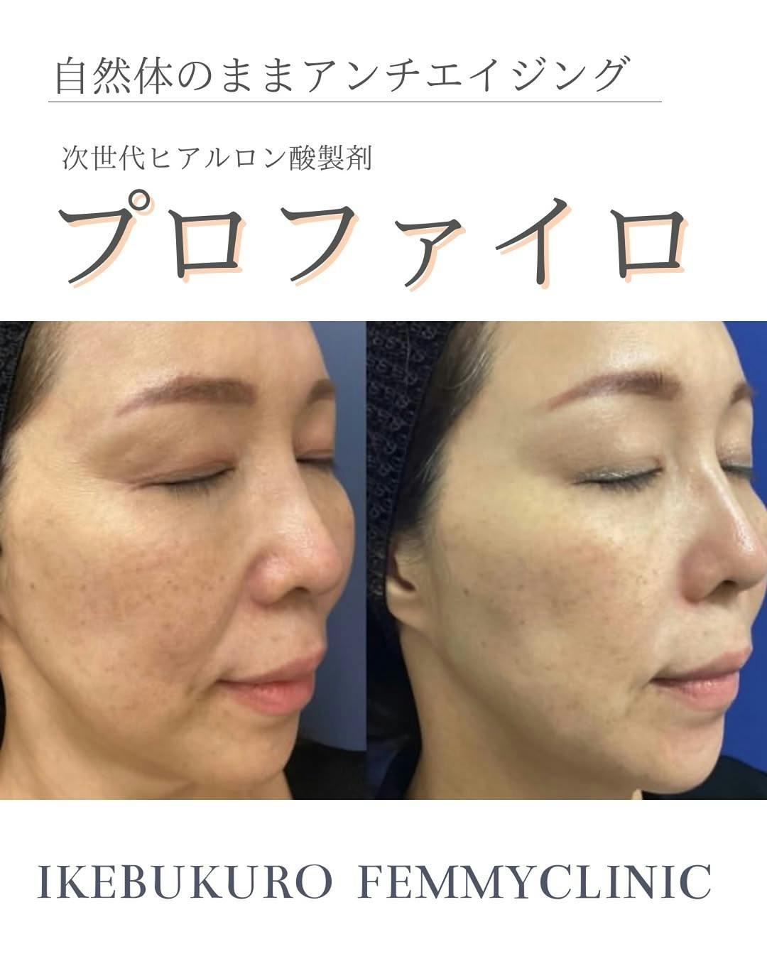 フェミークリニック 池袋院_before_aftar