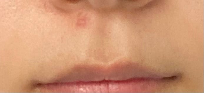 湘南美容クリニック 名古屋院で医療脱毛・鼻下の医療脱毛・乳輪の医療脱毛・うなじの医療脱毛・手の指・甲の医療脱毛・医療脱毛(顎下・首)・顎の医療脱毛・足の指・甲の医療脱毛・額の医療脱毛・Vライン医療脱毛・Iライン医療脱毛・Oライン医療脱毛・膝の医療脱毛・へそまわりの医療脱毛を受けたあいさんの写真