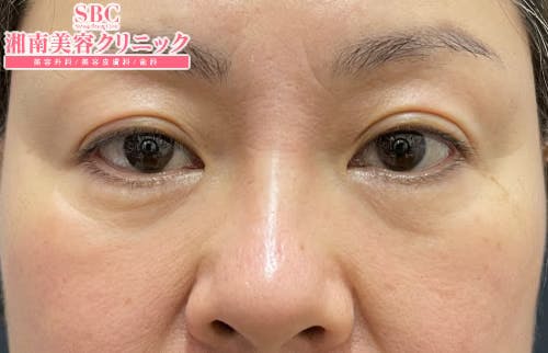 【女性・目元】ナチュラル脂肪注射コンデンスリッチ、ナチュラル脂肪注射ナノリッチ、目の下の切らないクマ・たるみ（ふくらみ）取り_before