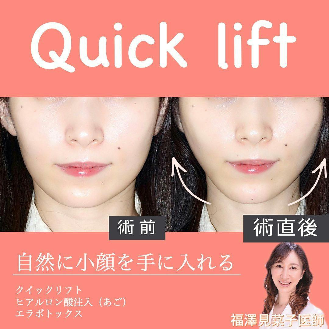 【女性・小顔】クイックリフト、エラボトックス、ヒアルロン酸（顎）_before_aftar