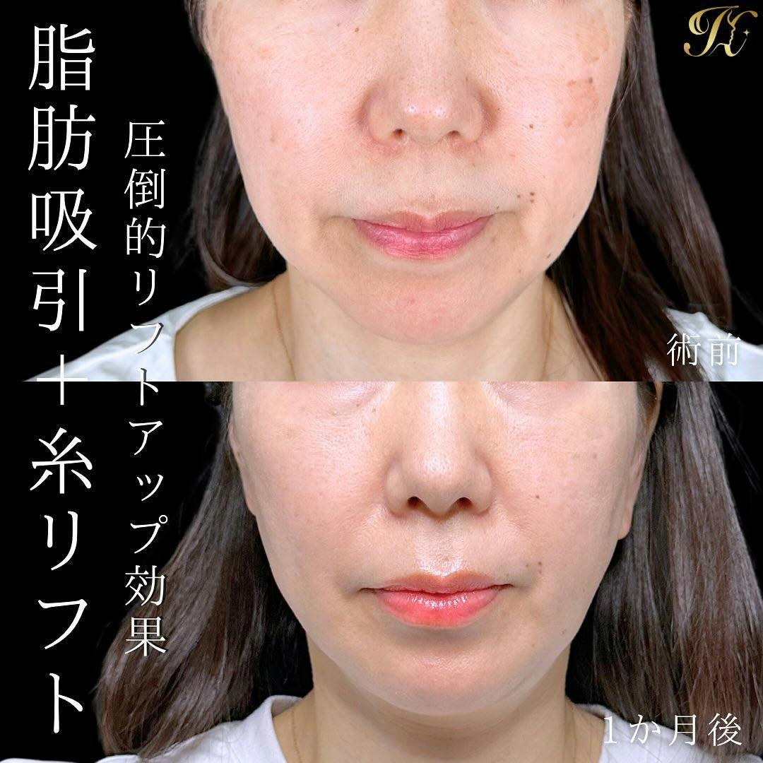 【女性・顔】糸リフト ・脂肪吸引(頬下・顎下)・ヒアルロン酸_before_aftar