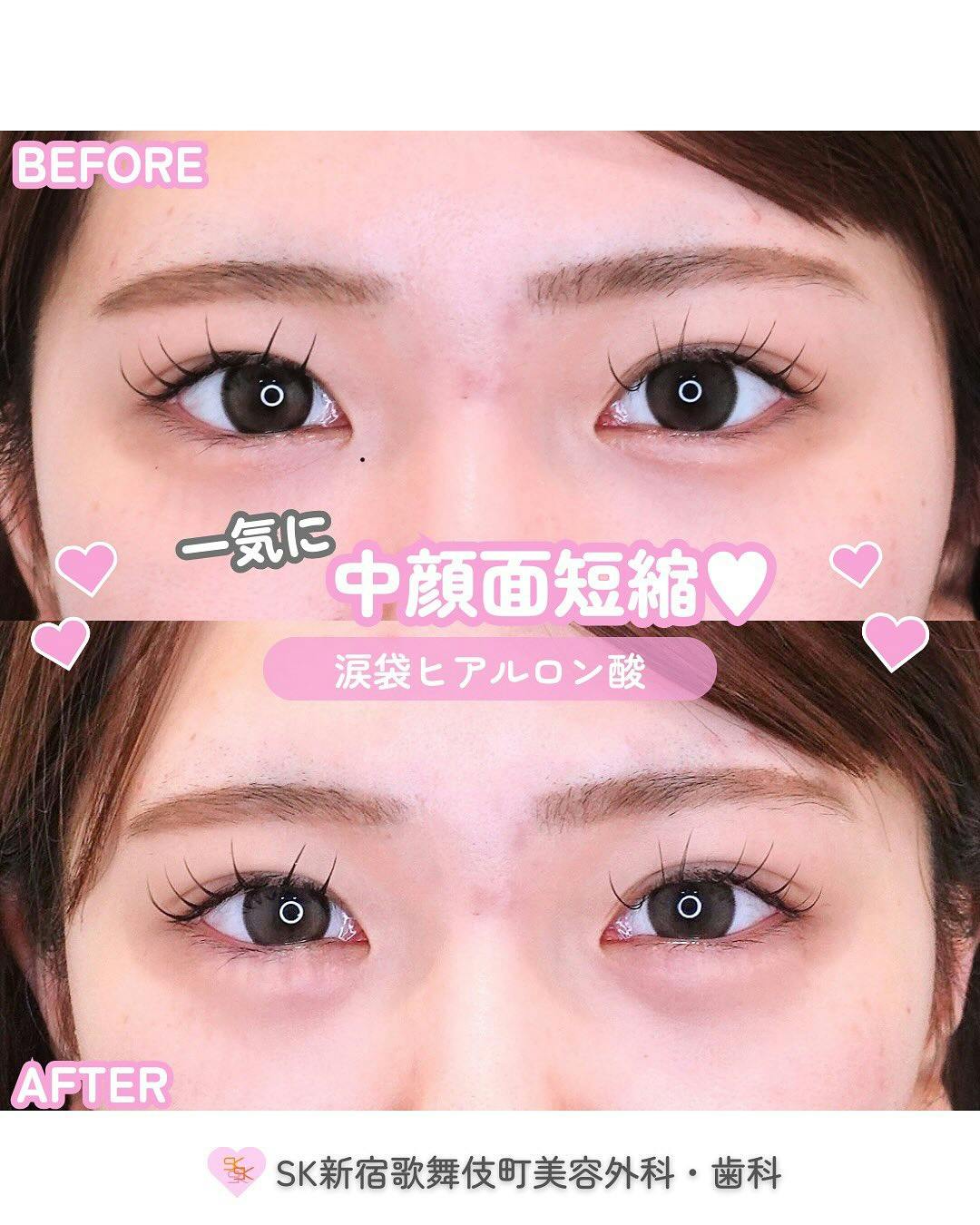 【女性・目元】涙袋ヒアルロン酸_before_aftar