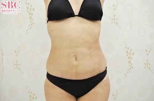 【女性・腹部】根こそぎVASER脂肪吸引、ライポマティック脂肪吸引、Aquicell（アキーセル）脂肪吸引_aftar