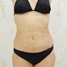 【女性・腹部】根こそぎVASER脂肪吸引、ライポマティック脂肪吸引、Aquicell(アキーセル)脂肪吸引_aftar