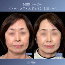 【60代女性・顔】美人レーザー(MIINレーザー) 【トーニング】【スポット シミ取り放題】_before_aftar