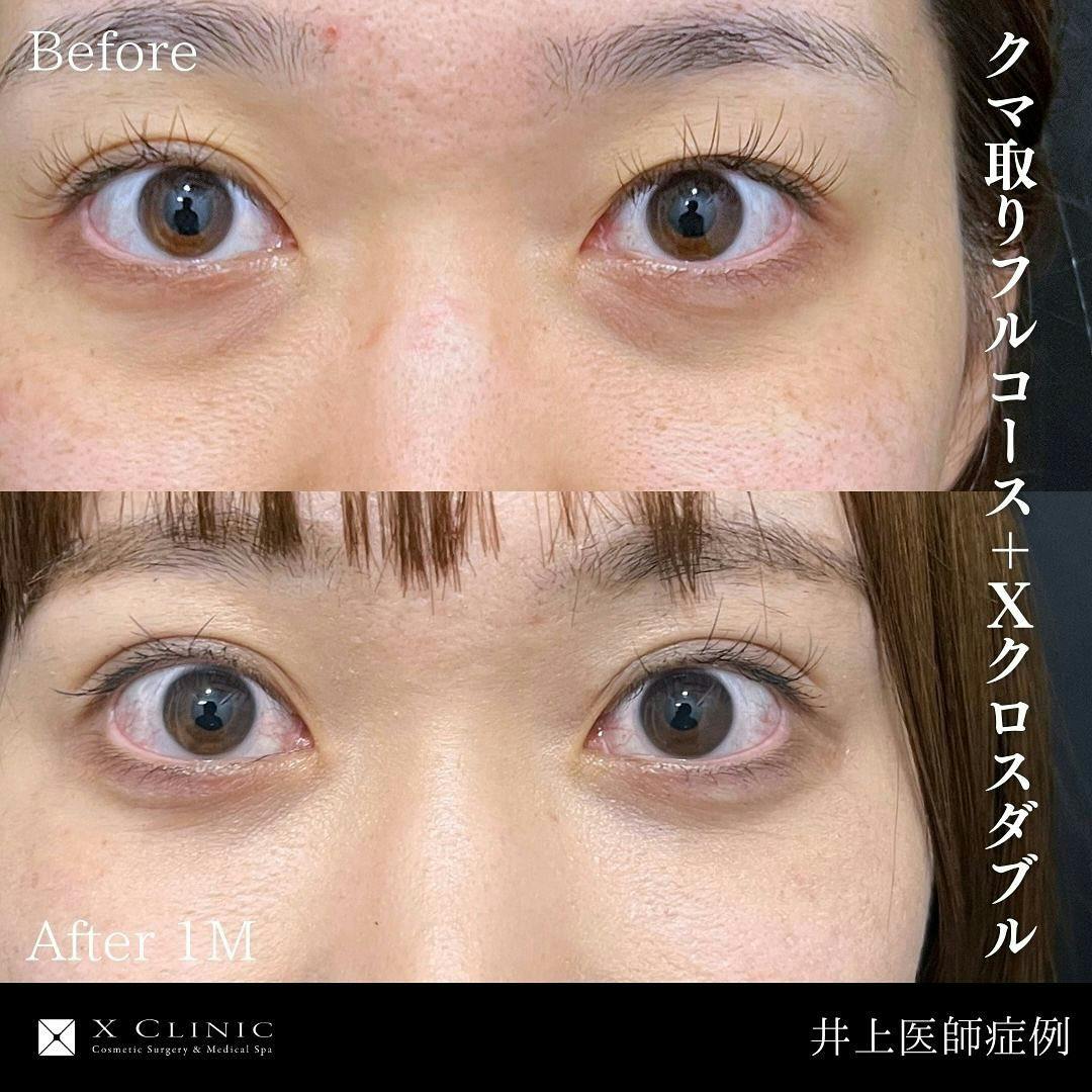 【20代女性・目元】クマ取りフルコース Xクロスダブル 高濃度PRP_before_aftar