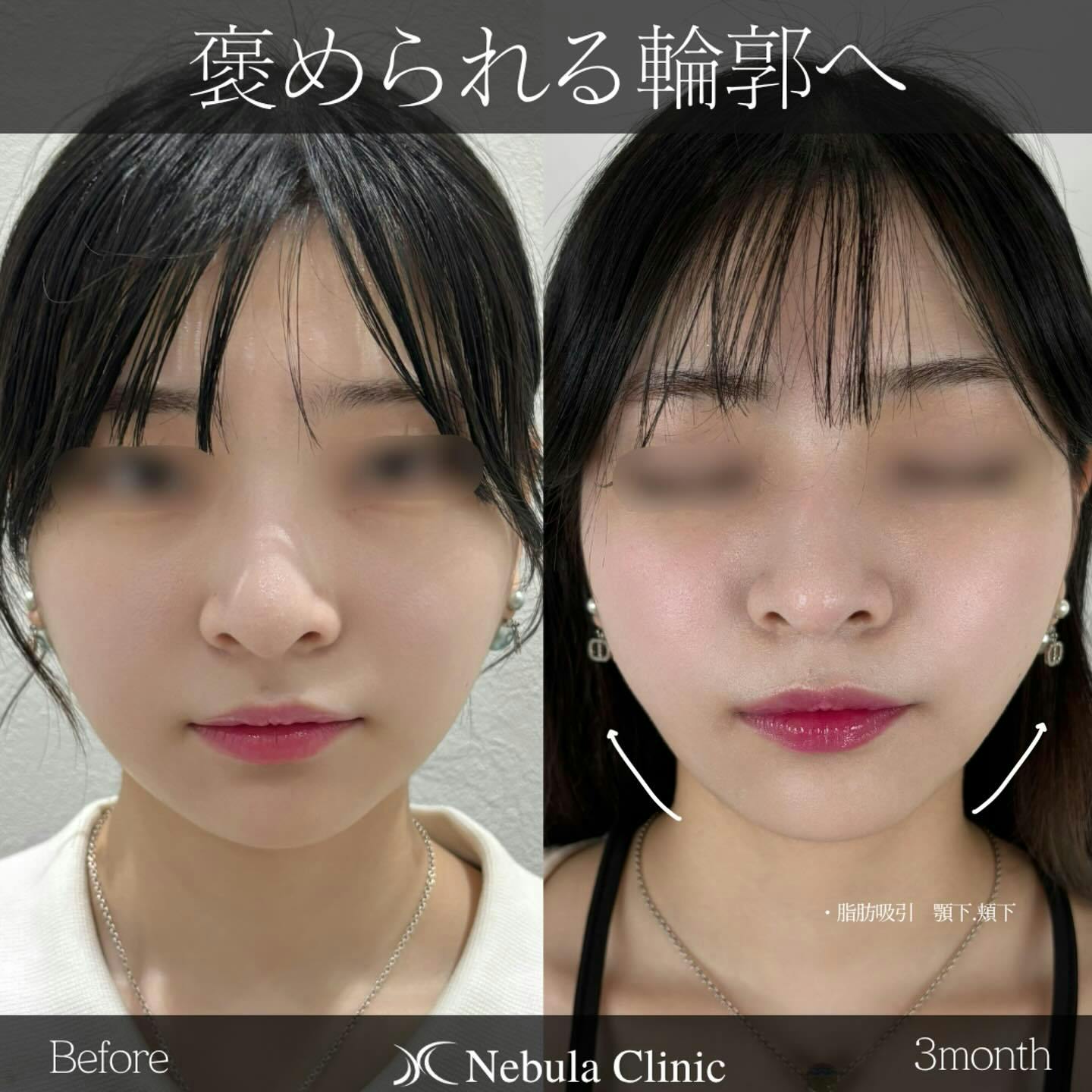 【女性・輪郭】脂肪吸引（顎下・頬下）_before_aftar