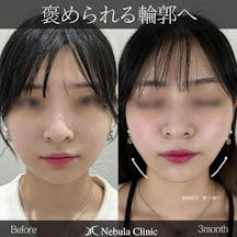 【女性・輪郭】脂肪吸引(顎下・頬下)_before_aftar