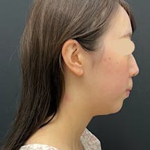 【20代女性・顔】小顔用脂肪吸引注射、顎ボトックス、顎ヒアルロン酸(クレヴィエル)_before