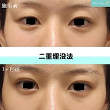 【女性・目元】二重埋没法_before_aftar